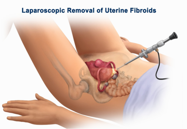 laparoscopic-fibroid-removal-procedure
